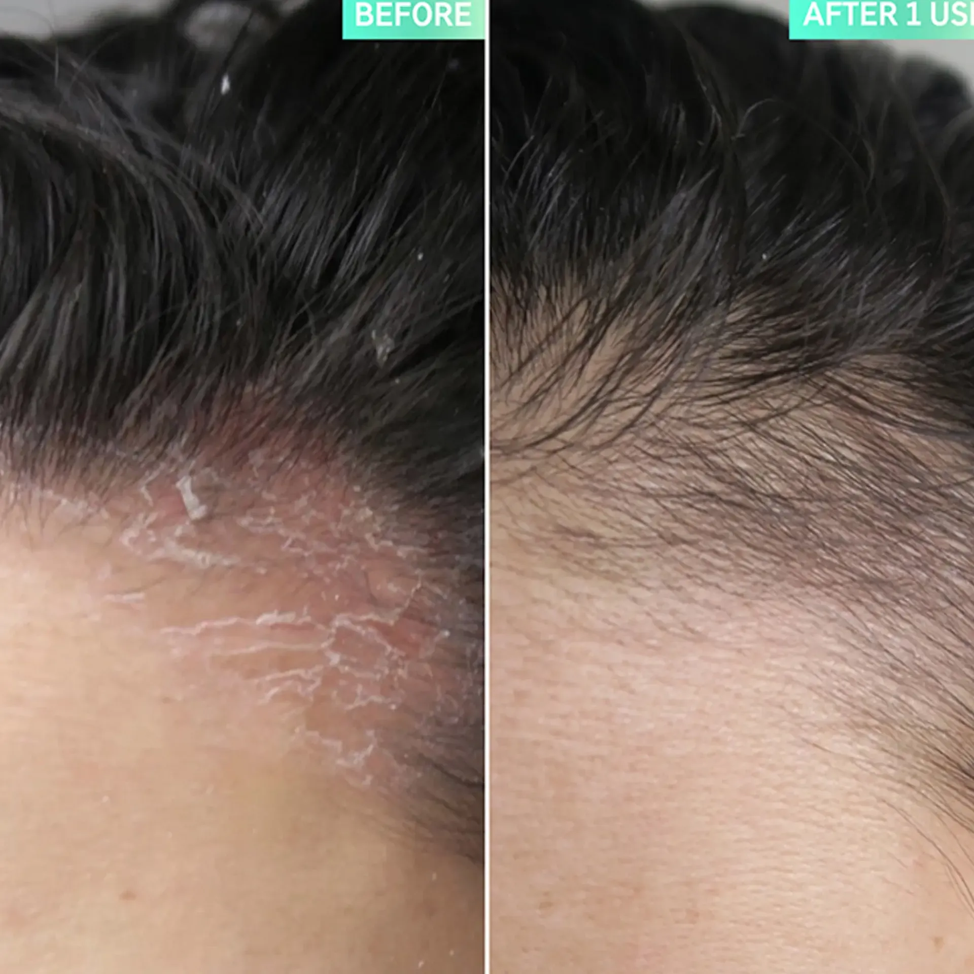 The INKEY List Hiustenhoito<Salicylic Acid Exfoliating Scalp Treatment kuorinta hiuspohjalle 150 ml